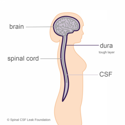 spinal fluid leak in brain