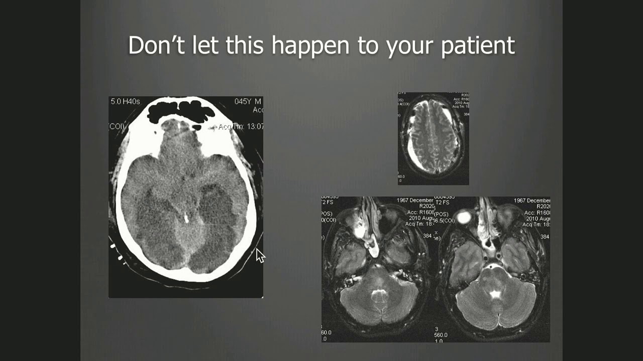 Wouter Schievink MD - Serious Complications of Intracranial Hypotension