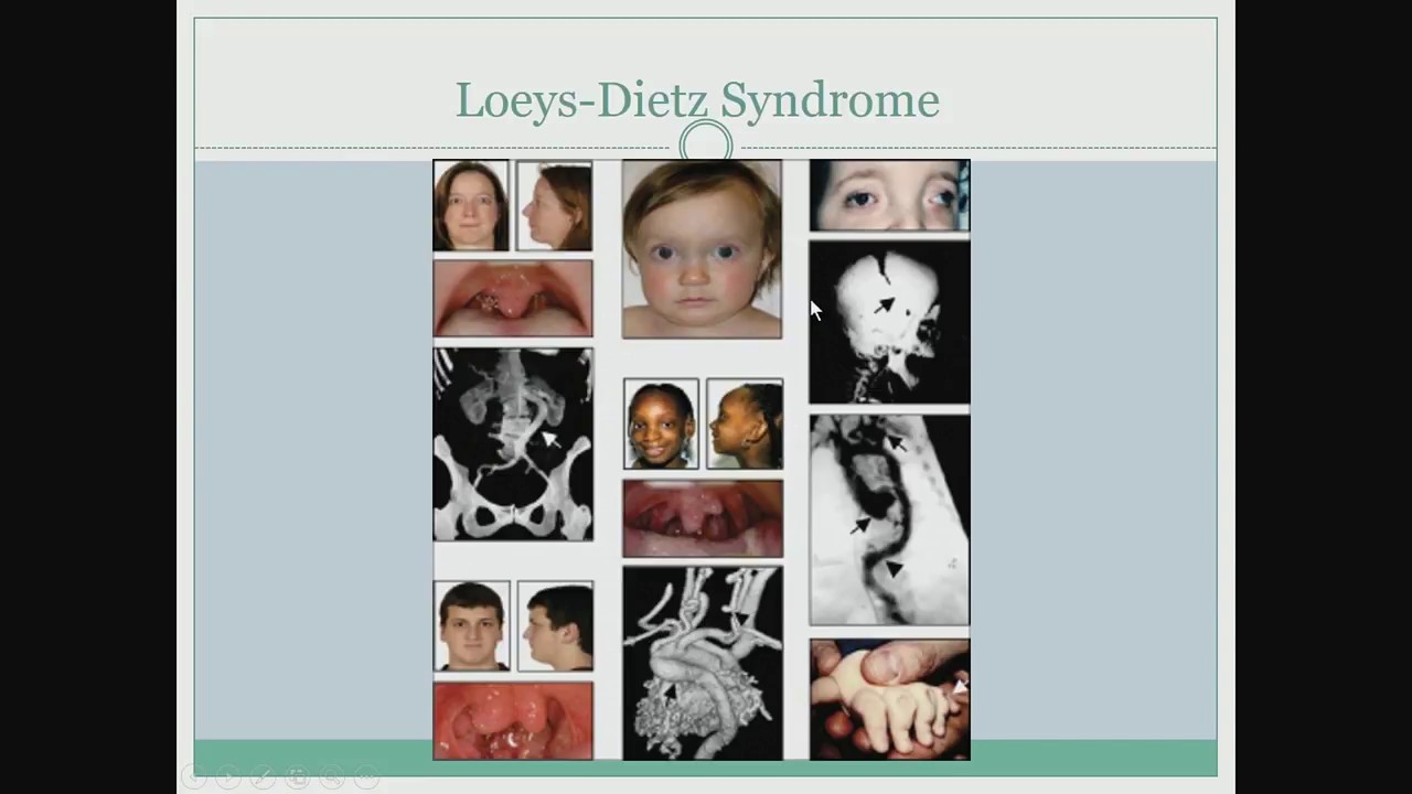 Clair Francomano MD – Hereditary Disorders of Connective Tissue