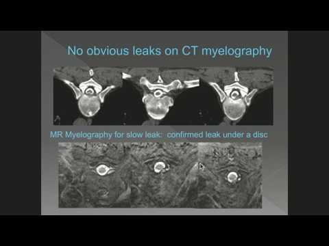 Linda Gray-Leithe MD & Peter G. Kranz MD - Percutaneous Treatment Approaches: Duke