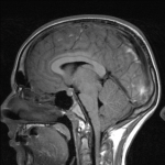 MRI sag1