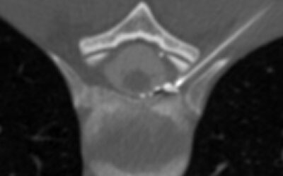 Expanding Epidural Patching Techniques for Spinal CSF Leak