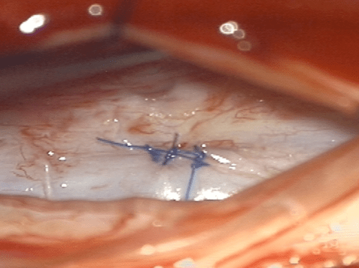 In this example of surgical treatment for spinal csf leak, an image taken during surgery is presented showing a hole in the patient's dura mater