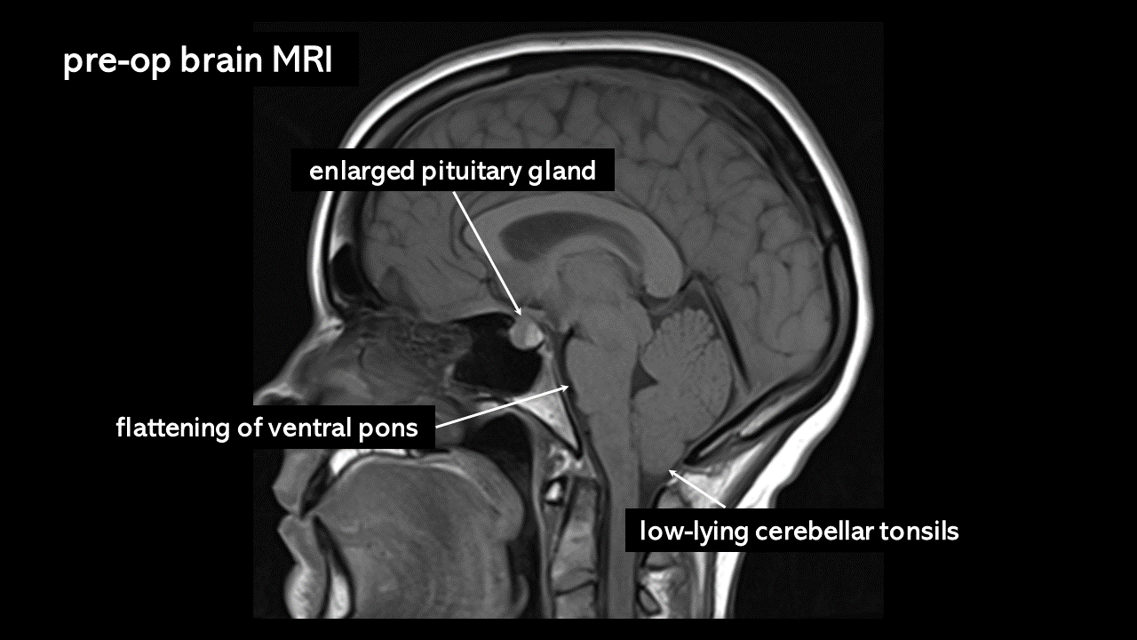 enlarged pituitary gland mri