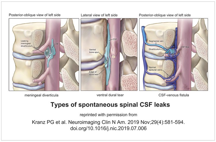 An image illustrating the various types of spontaneous spinal CSF leaks. Understanding of anatomic leak types has helped imaging strategies evolve so spinal CSF leaks can be better diagnosed. 