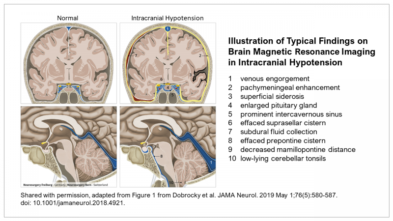 Illustration of typical findings on brain MRI in intracranial hypotension. Despite increasing awareness, misdiagnosis remains the rule rather than the exception when it comes to SIH.