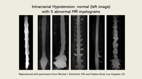 Diagnosis of Spinal CSF leak - Diagnosis - Spinal CSF Leak Foundation