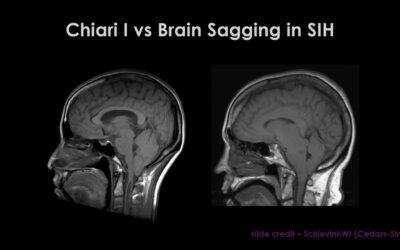 Brain Awareness Week 2021: Brain Descent and Low-Lying Cerebellar Tonsils in Spinal CSF Leak