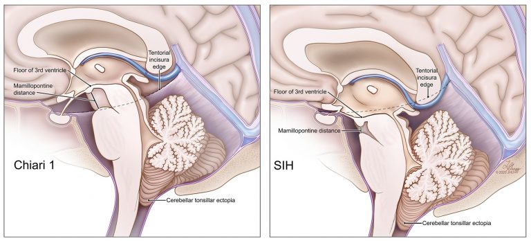 chiari1 vs sih