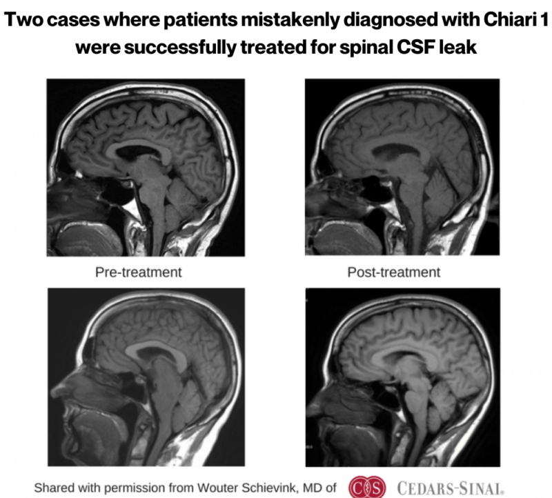 two cases where patients mistakenly diagnosed with Chiari 1 were successfully treated for spinal CSF leak