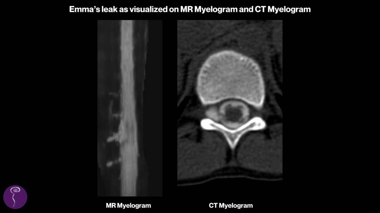 Emma: Imaging showing what her spinal CSF leak looked like