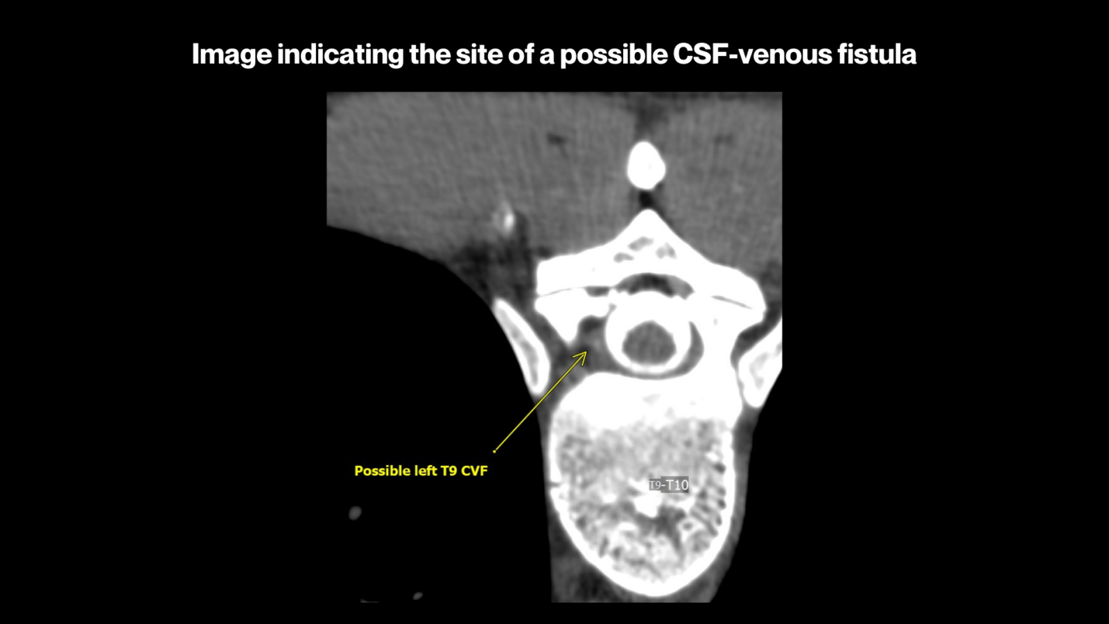 Hailey's story: A medical image indicating the site of a possible CSF-venous fistula
