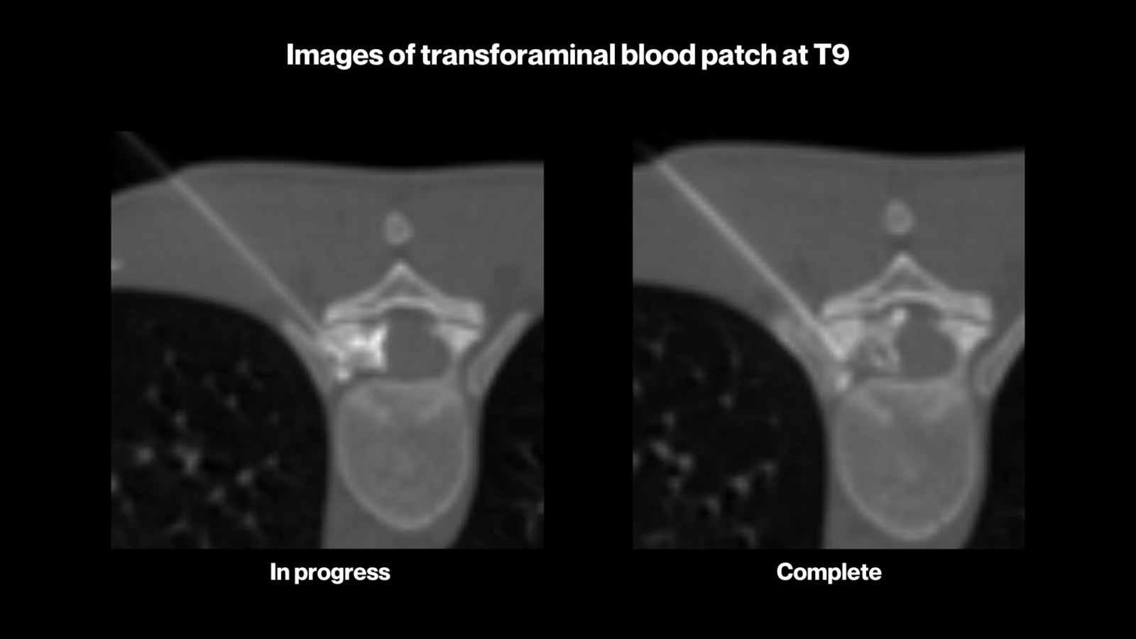 Hailey's story: A medical image showing the progress of her transforaminal blood patch at T9