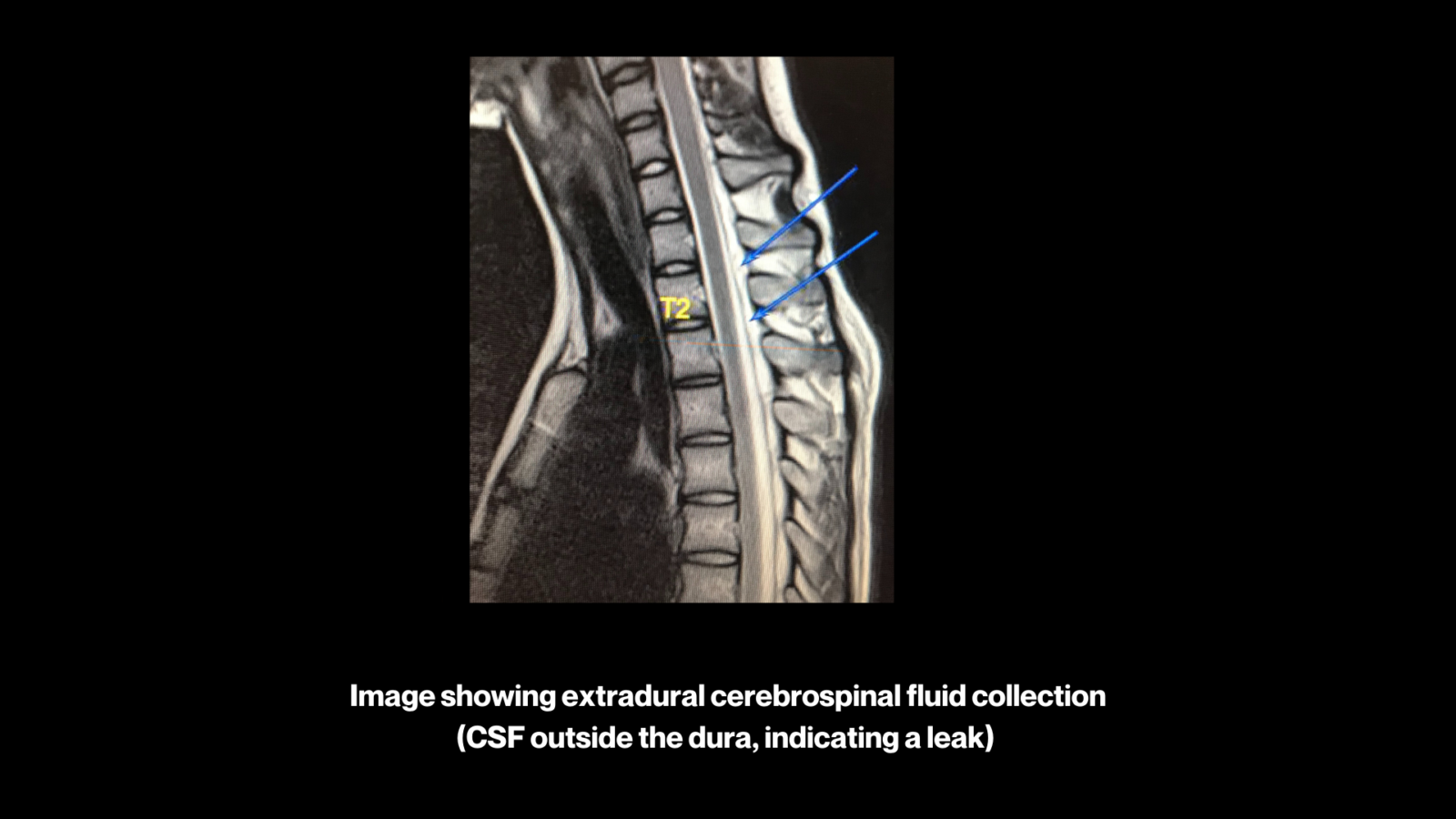 Jack's story: a medical image showing extradural CSF collection
