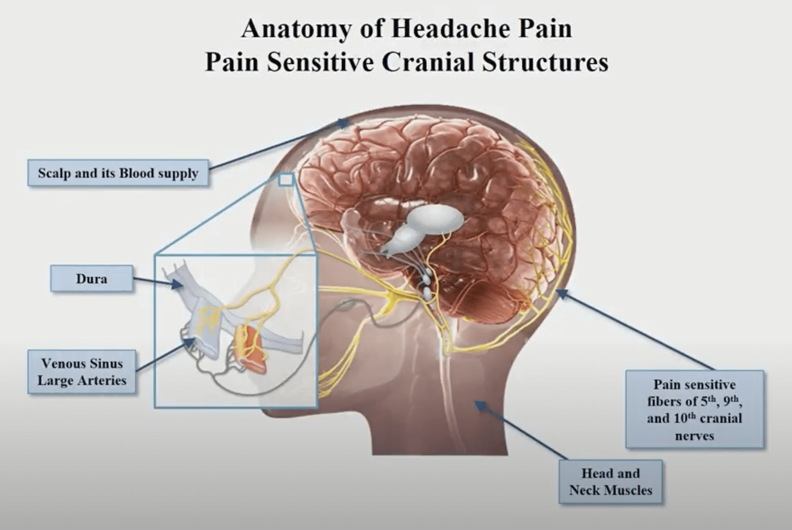 A medical diagram showing the anatomy of pain-sensitive cranial structures