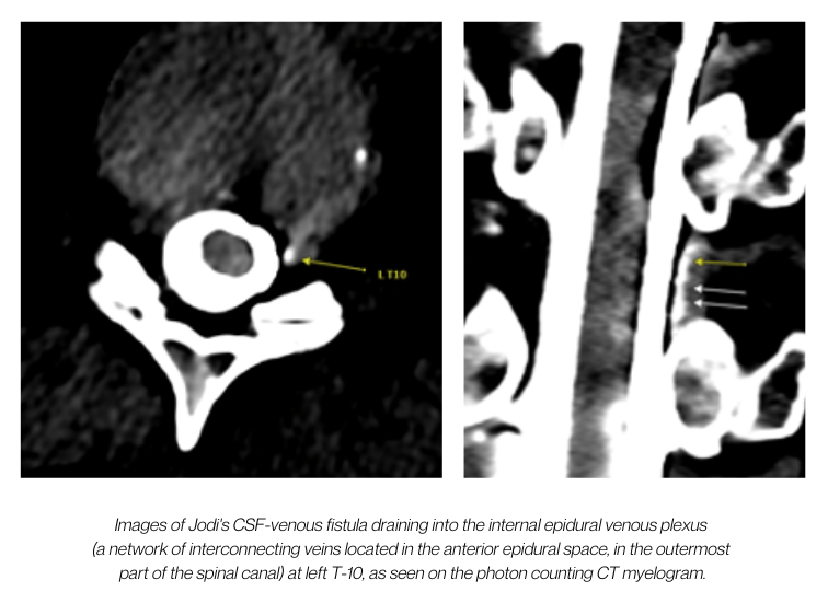 Images of Jodi's CSF-venous fistula, as seen on PCCT