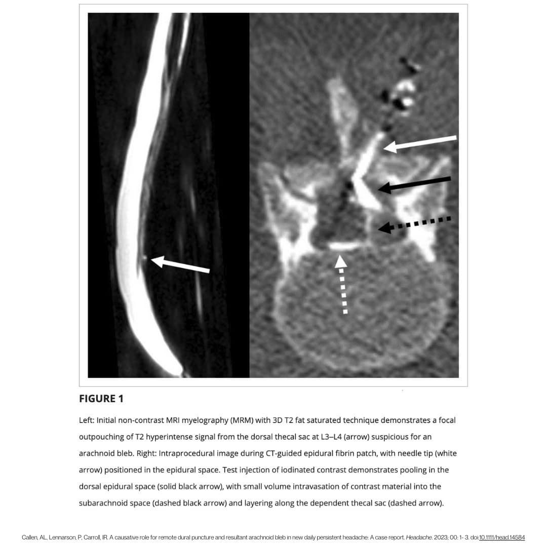 remote dural puncture