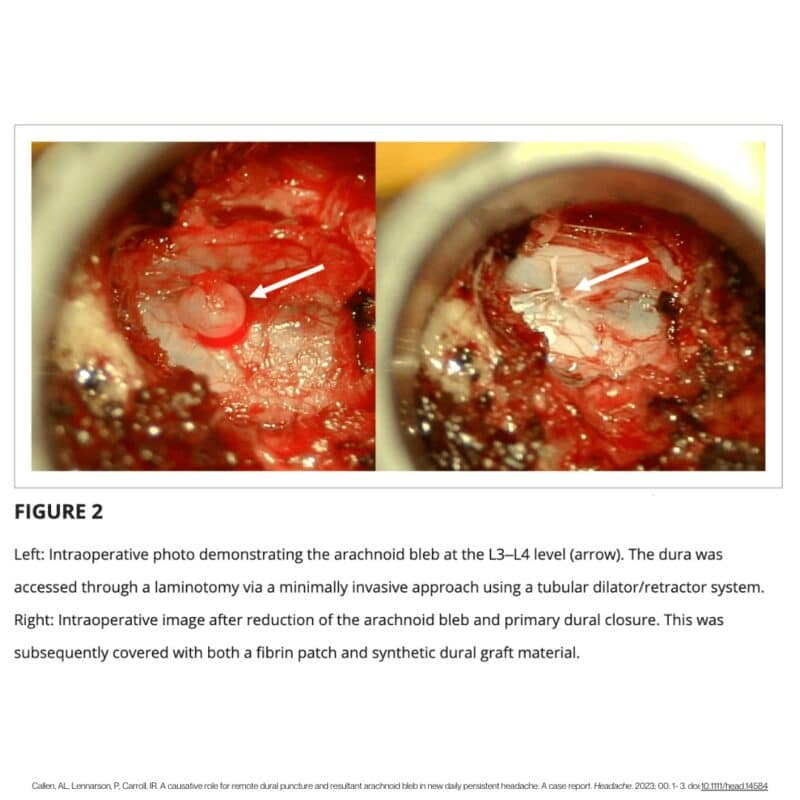 remote dural puncture
