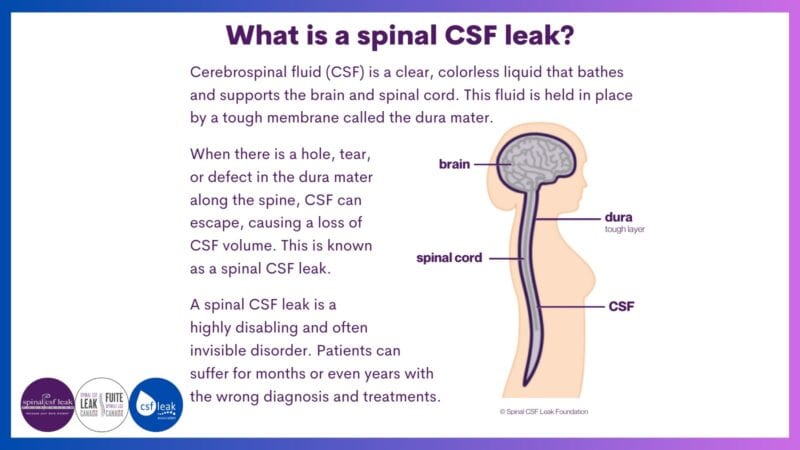 Leakweek 2023: What is a spinal CSF leak?