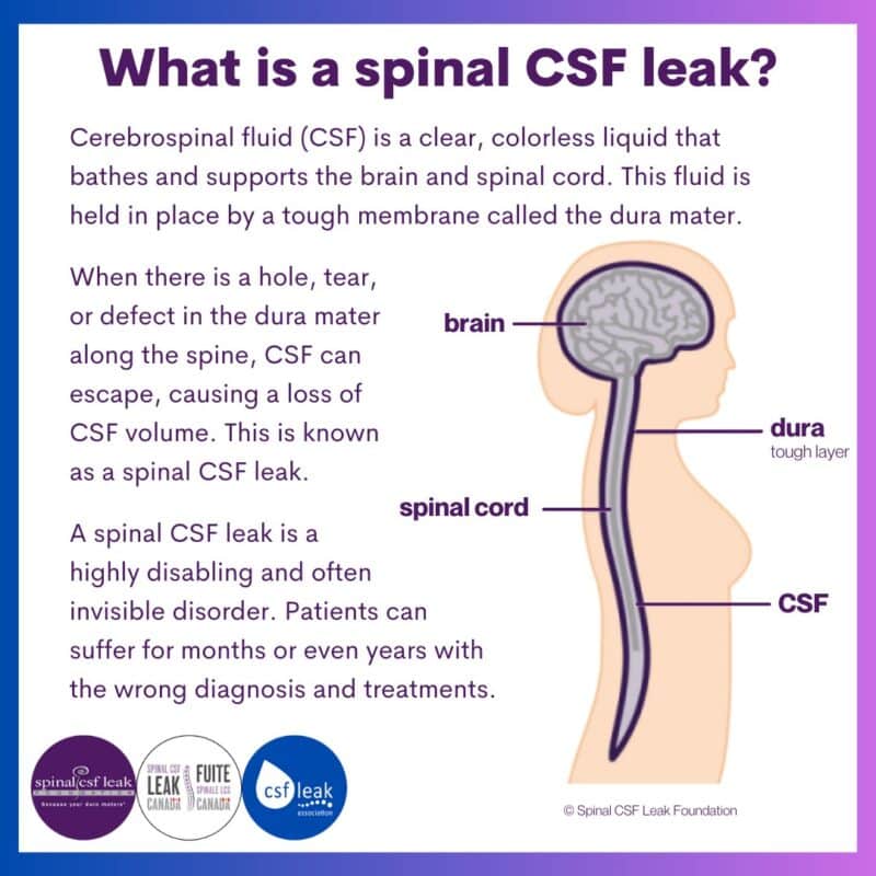 Leakweek 2023: What is a spinal CSF leak?