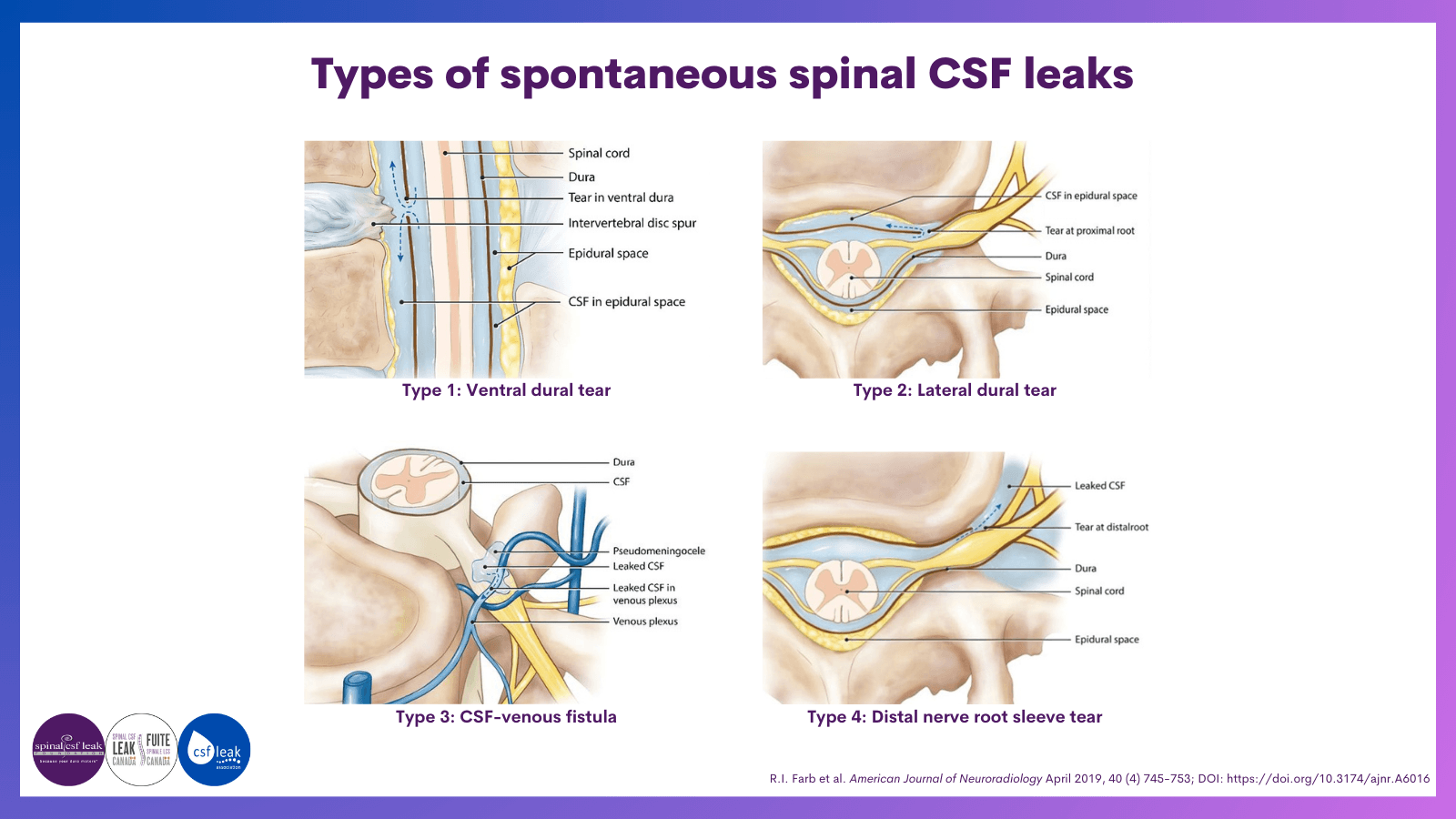 types of spontaneous spinal csf leaks